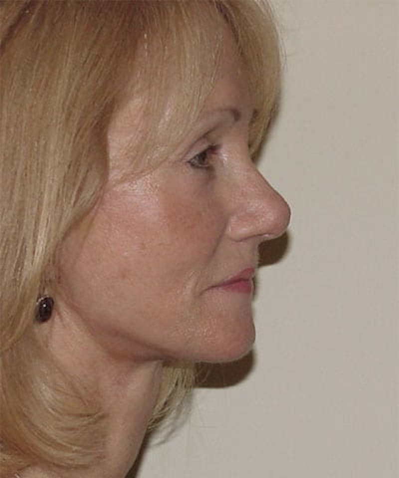 Facelift Before & After Gallery - Patient 133066460 - Image 2