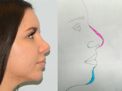 Chin Augmentation Before & After Gallery - Patient 133066473 - Image 2