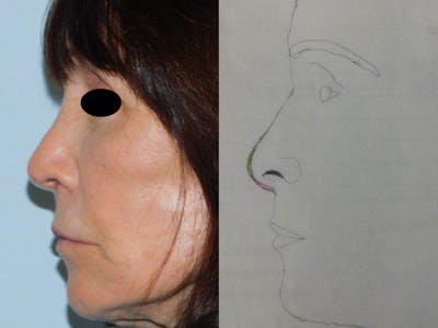 Revision Rhinoplasty Before & After Gallery - Patient 133066464 - Image 2