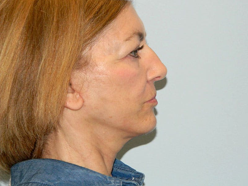 Mini-Facelift Before & After Gallery - Patient 133066458 - Image 6
