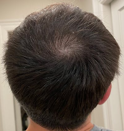PRP Injections for Hair Loss Before & After Gallery - Patient 133066459 - Image 2