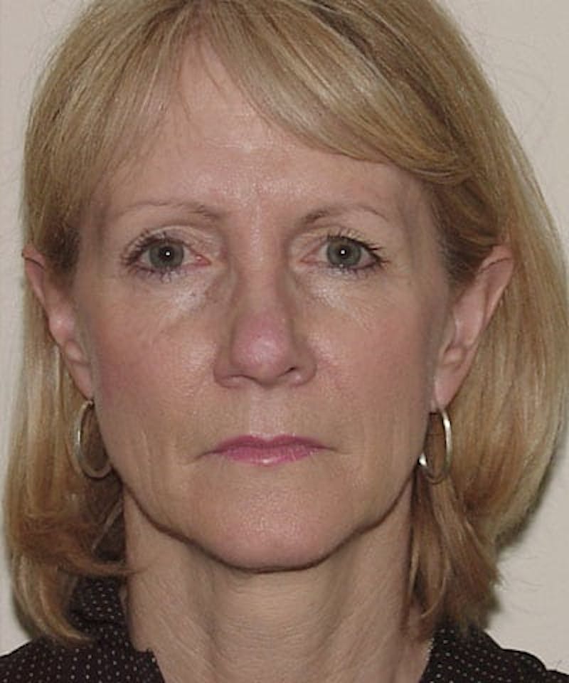 Facelift Before & After Gallery - Patient 133066460 - Image 3