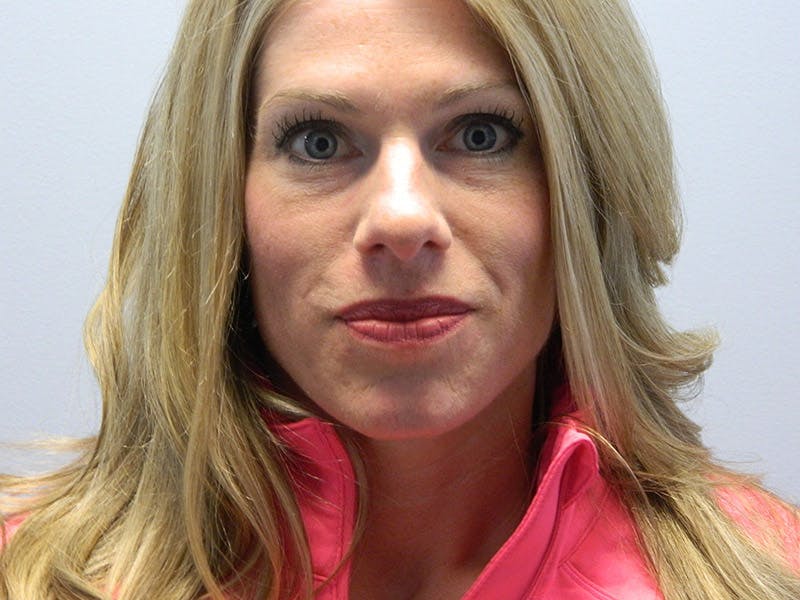 Rhinoplasty Before & After Gallery - Patient 133066463 - Image 3