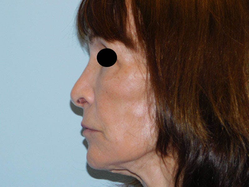 Revision Rhinoplasty Before & After Gallery - Patient 133066464 - Image 3