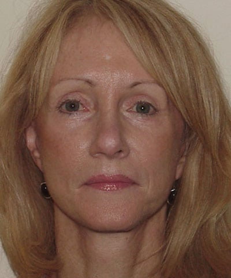 Facelift Before & After Gallery - Patient 133066460 - Image 4