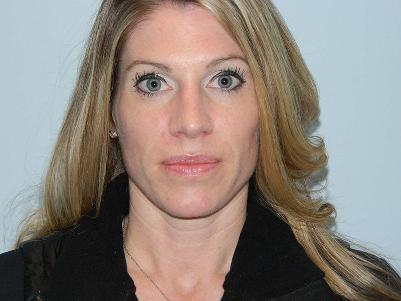 Rhinoplasty Before & After Gallery - Patient 133066463 - Image 4
