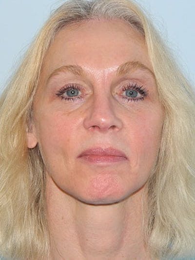 Blepharoplasty (Eyelid Lift) Before & After Gallery - Patient 133066461 - Image 2