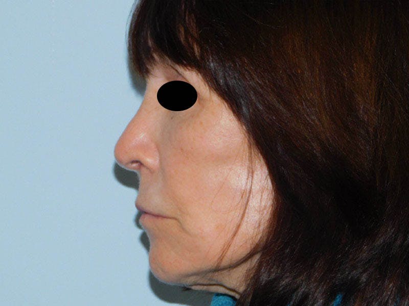 Revision Rhinoplasty Before & After Gallery - Patient 133066464 - Image 4