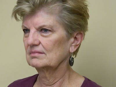 Mini-Facelift Before & After Gallery - Patient 133066468 - Image 1