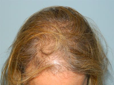 PRP Injections for Hair Loss Before & After Gallery - Patient 133066462 - Image 1