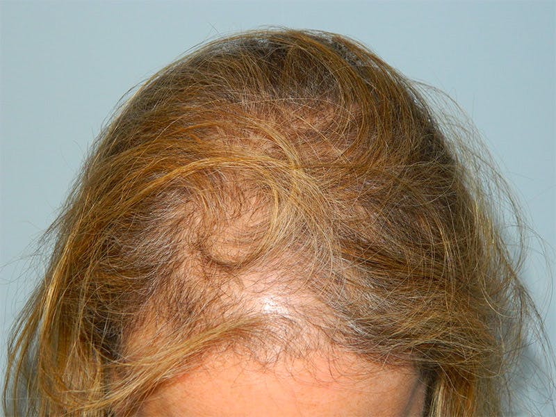 PRP Injections for Hair Loss Before & After Gallery - Patient 133066462 - Image 1