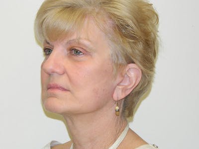 Mini-Facelift Before & After Gallery - Patient 133066468 - Image 2