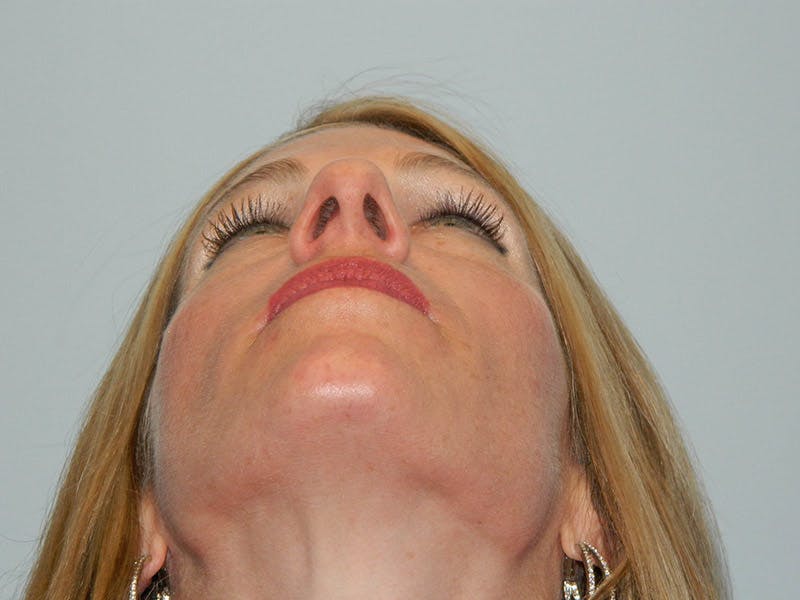 Rhinoplasty Before & After Gallery - Patient 133066463 - Image 5
