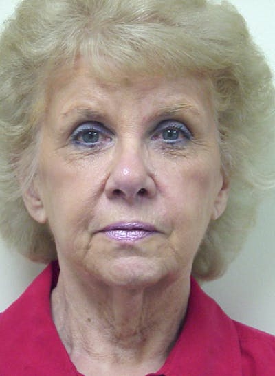 Facelift Before & After Gallery - Patient 133066466 - Image 1