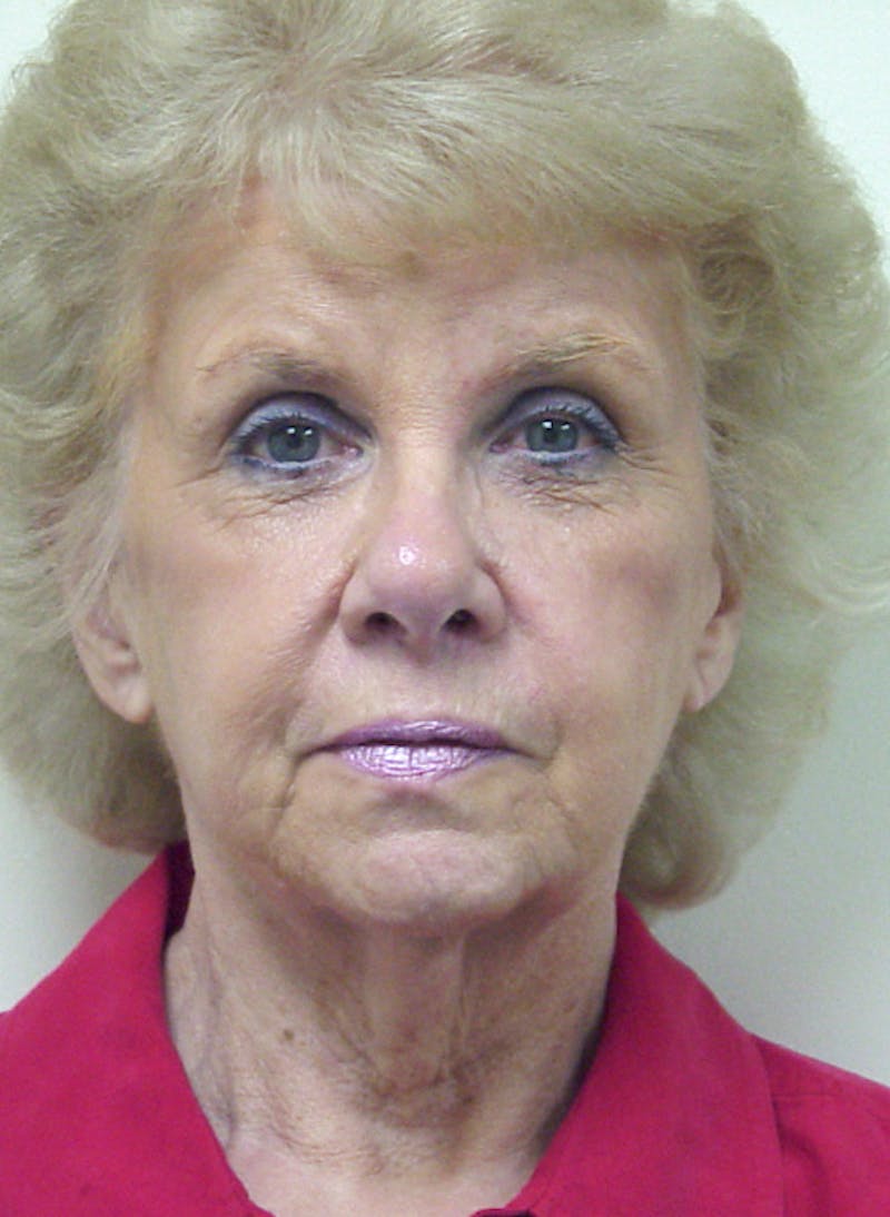 Facelift Before & After Gallery - Patient 133066466 - Image 1