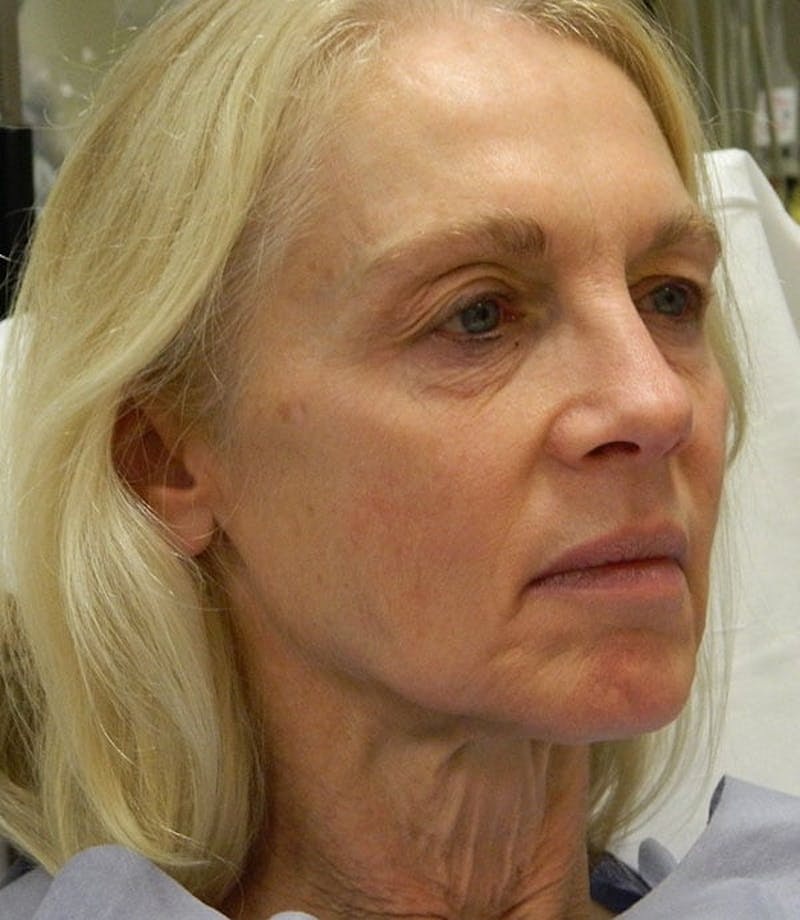 Blepharoplasty (Eyelid Lift) Before & After Gallery - Patient 133066461 - Image 3