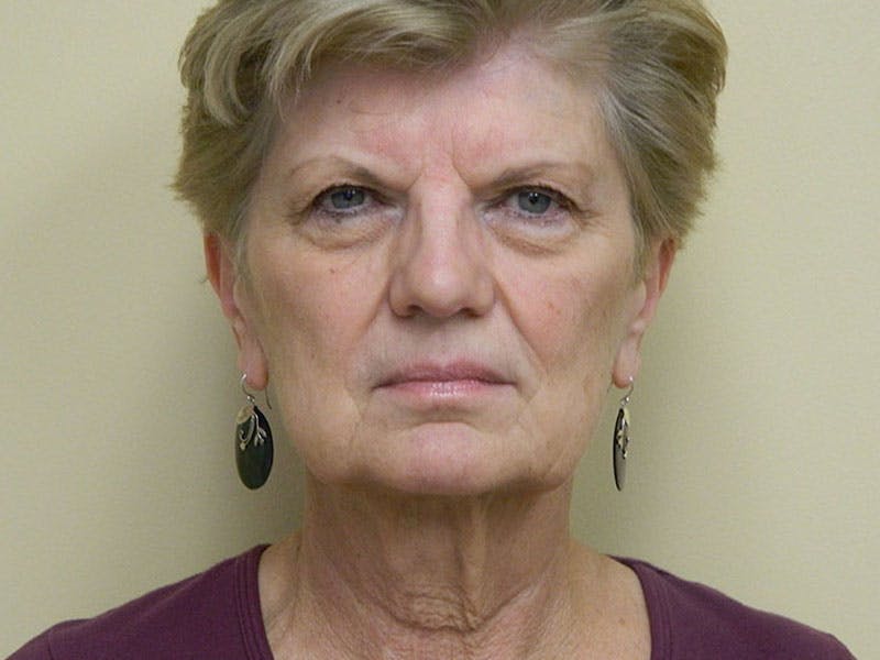 Mini-Facelift Before & After Gallery - Patient 133066468 - Image 3