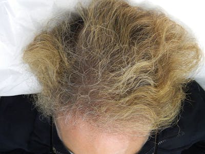 PRP Injections for Hair Loss Before & After Gallery - Patient 133066462 - Image 2