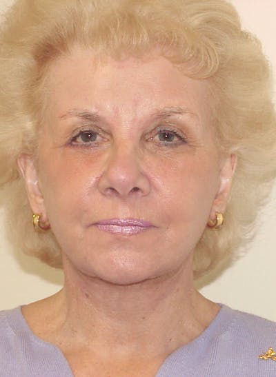 Facelift Before & After Gallery - Patient 133066466 - Image 2