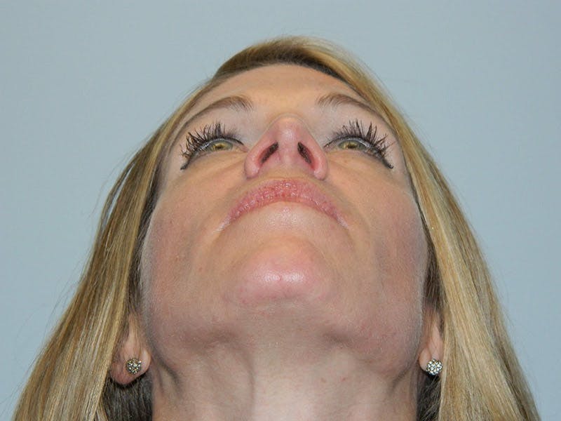Rhinoplasty Before & After Gallery - Patient 133066463 - Image 6