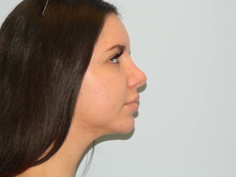 Chin Augmentation Before & After Gallery - Patient 133066473 - Image 4