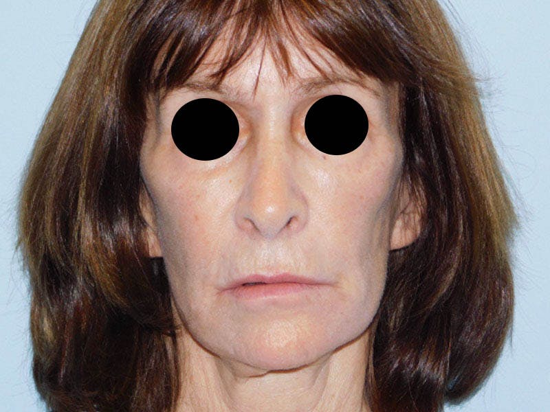 Revision Rhinoplasty Before & After Gallery - Patient 133066464 - Image 7