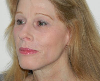 Fraxel Laser Resurfacing Before & After Gallery - Patient 133066470 - Image 2