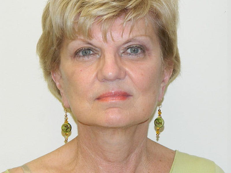 Mini-Facelift Before & After Gallery - Patient 133066468 - Image 4