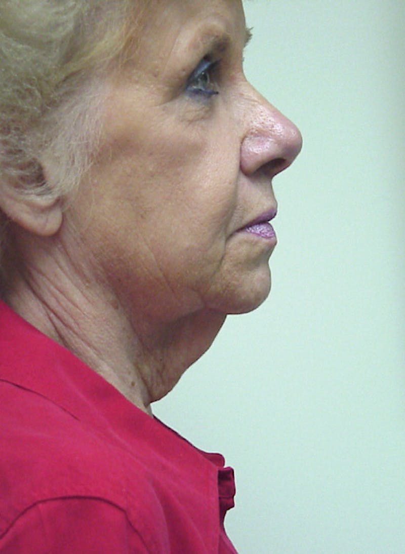 Facelift Before & After Gallery - Patient 133066466 - Image 3