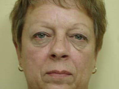 Blepharoplasty (Eyelid Lift) Before & After Gallery - Patient 133066465 - Image 1