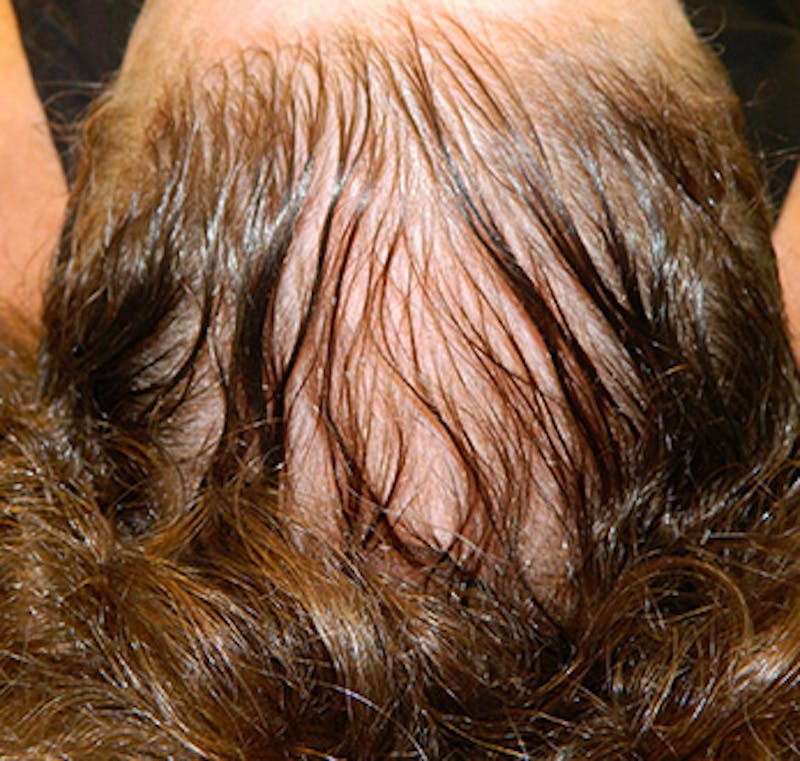 PRP Injections for Hair Loss Before & After Gallery - Patient 133066467 - Image 1