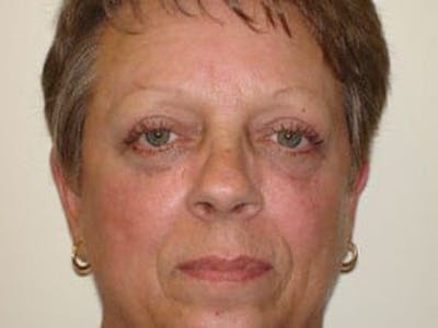 Blepharoplasty (Eyelid Lift) Before & After Gallery - Patient 133066465 - Image 2