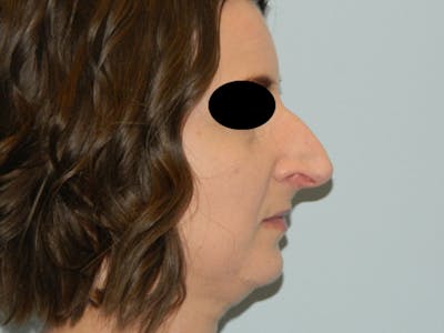 Rhinoplasty Before & After Gallery - Patient 133066496 - Image 1