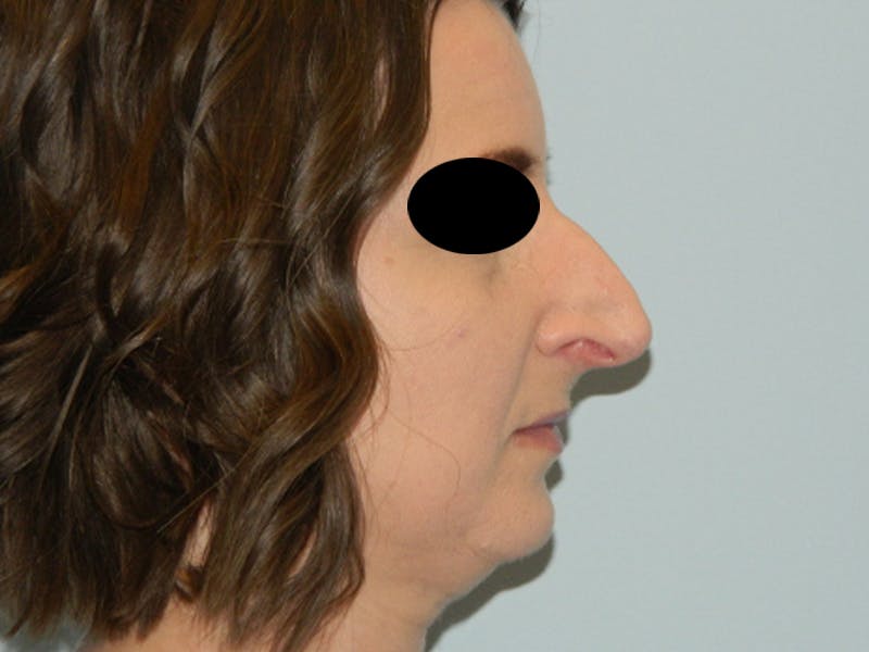 Rhinoplasty Before & After Gallery - Patient 133066496 - Image 1