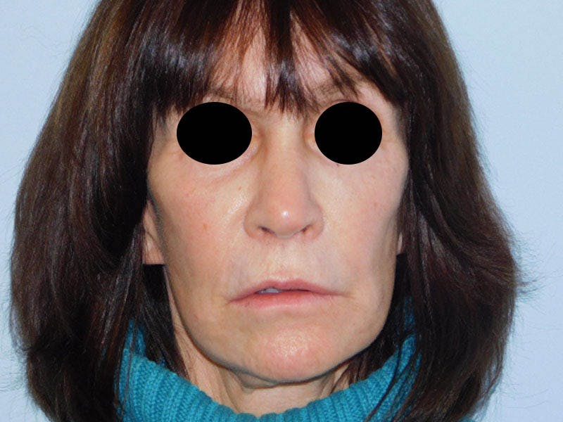 Revision Rhinoplasty Before & After Gallery - Patient 133066464 - Image 8