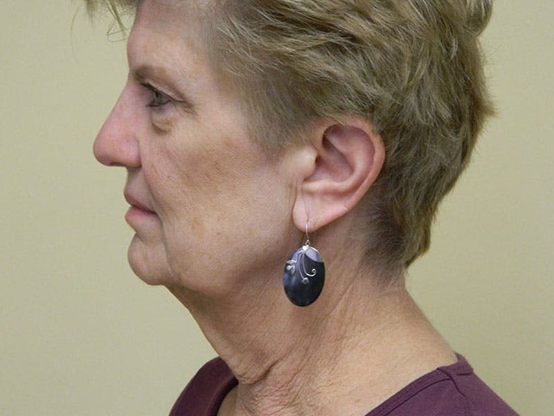 Mini-Facelift Before & After Gallery - Patient 133066468 - Image 5