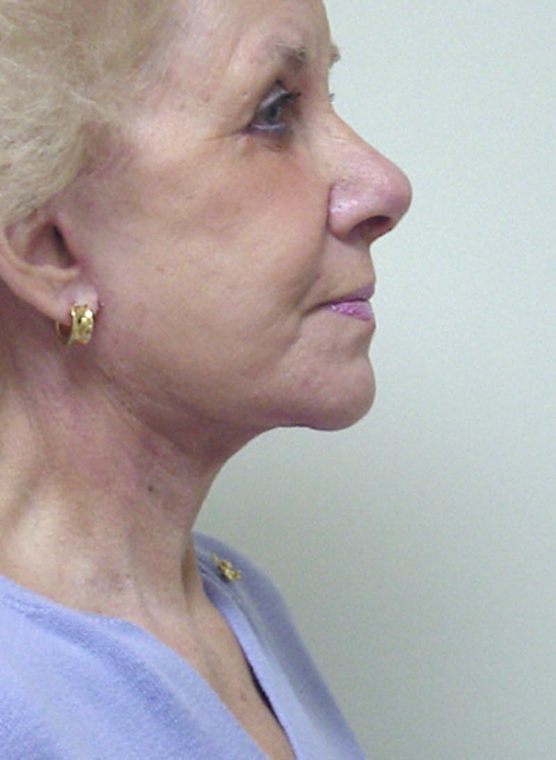 Facelift Before & After Gallery - Patient 133066466 - Image 4