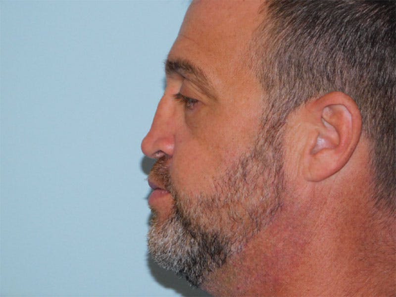 Revision Rhinoplasty Before & After Gallery - Patient 133066477 - Image 1
