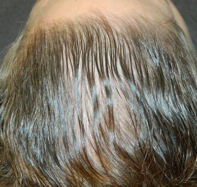 PRP Injections for Hair Loss Before & After Gallery - Patient 133066467 - Image 2