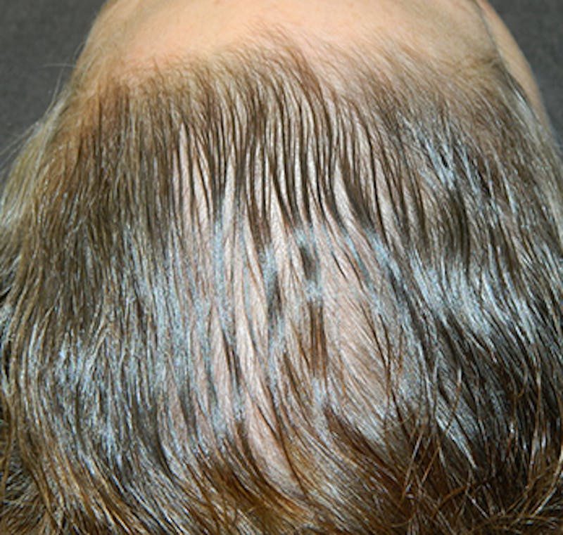 PRP Injections for Hair Loss Before & After Gallery - Patient 133066467 - Image 2