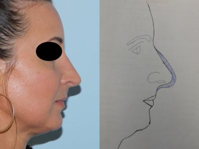 Rhinoplasty Before & After Gallery - Patient 133066496 - Image 2