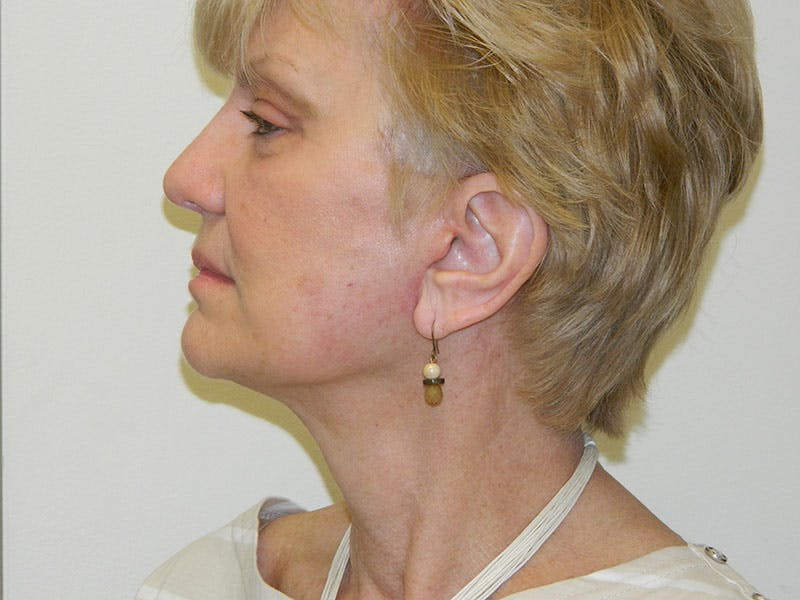 Mini-Facelift Before & After Gallery - Patient 133066468 - Image 6