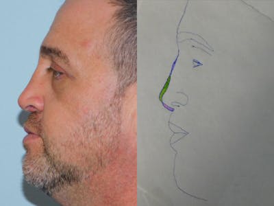 Revision Rhinoplasty Before & After Gallery - Patient 133066477 - Image 2