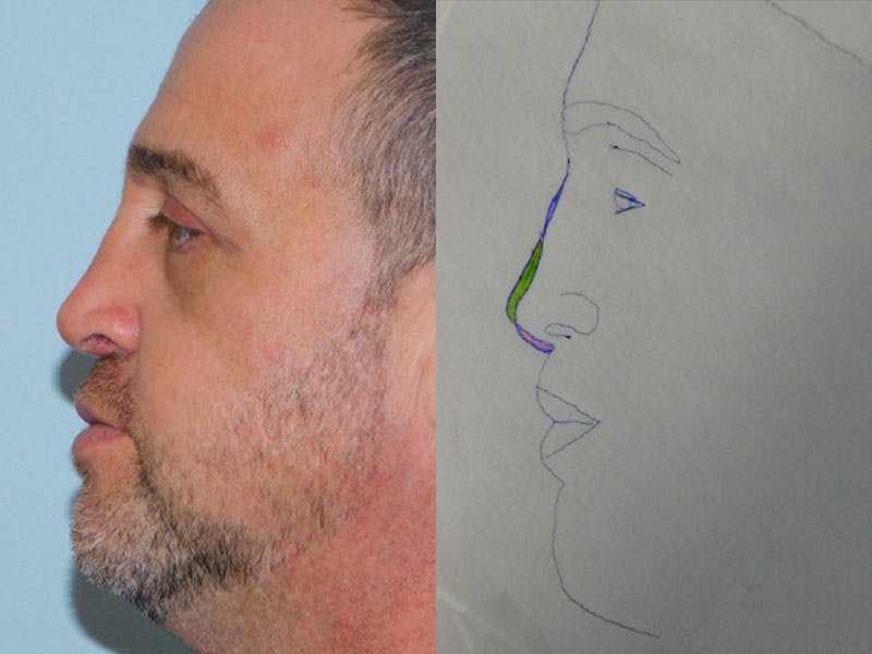 Revision Rhinoplasty Before & After Gallery - Patient 133066477 - Image 2