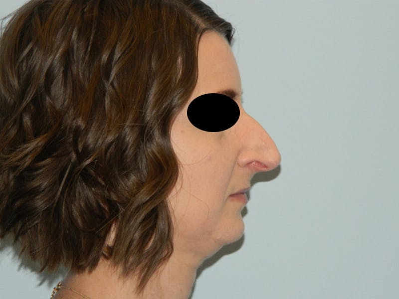 Rhinoplasty Before & After Gallery - Patient 133066496 - Image 3