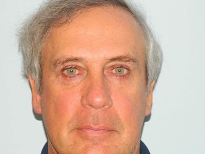 Blepharoplasty (Eyelid Lift) Before & After Gallery - Patient 133066469 - Image 2