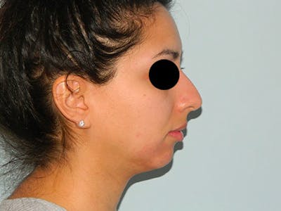 Non-Surgical Rhinoplasty and Injectable Fillers Before & After Gallery - Patient 133066471 - Image 1