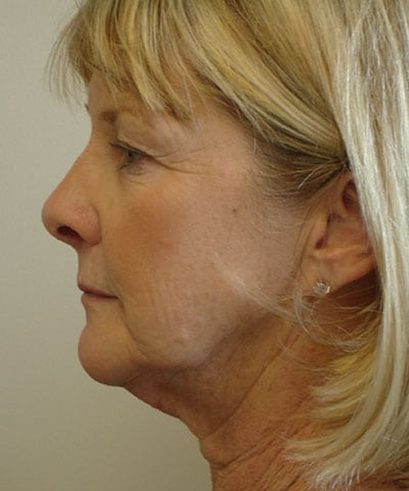 Facelift Before & After Gallery - Patient 133066474 - Image 1