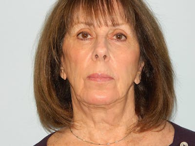 Mini-Facelift Before & After Gallery - Patient 133066476 - Image 1