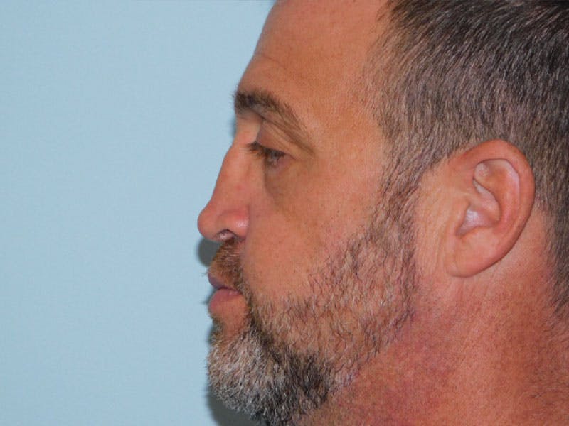 Revision Rhinoplasty Before & After Gallery - Patient 133066477 - Image 3